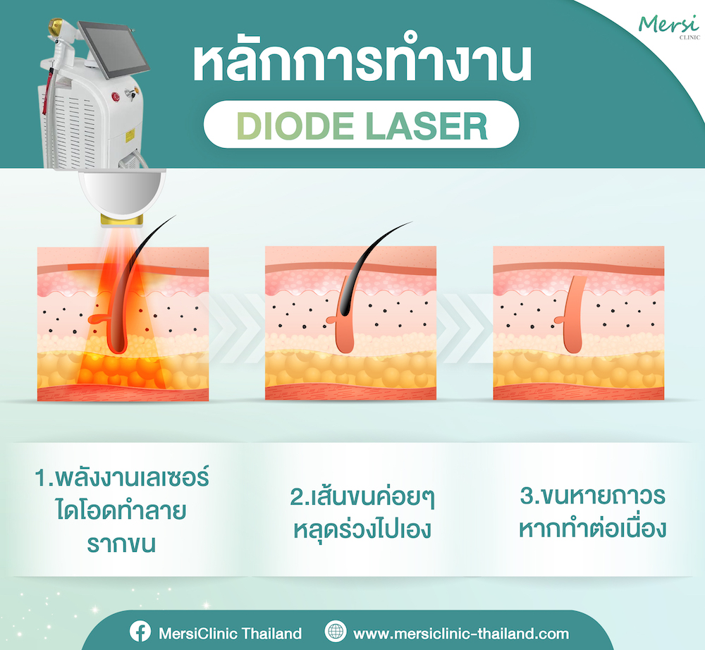 เลเซอร์กำจัดขน Diode Laser ดีอย่างไร ทำไมจึงเป็นที่นิยม - Mersi Clinic  เมอร์ซี่คลินิก สถาบันเพื่อสุขภาพและความงาม